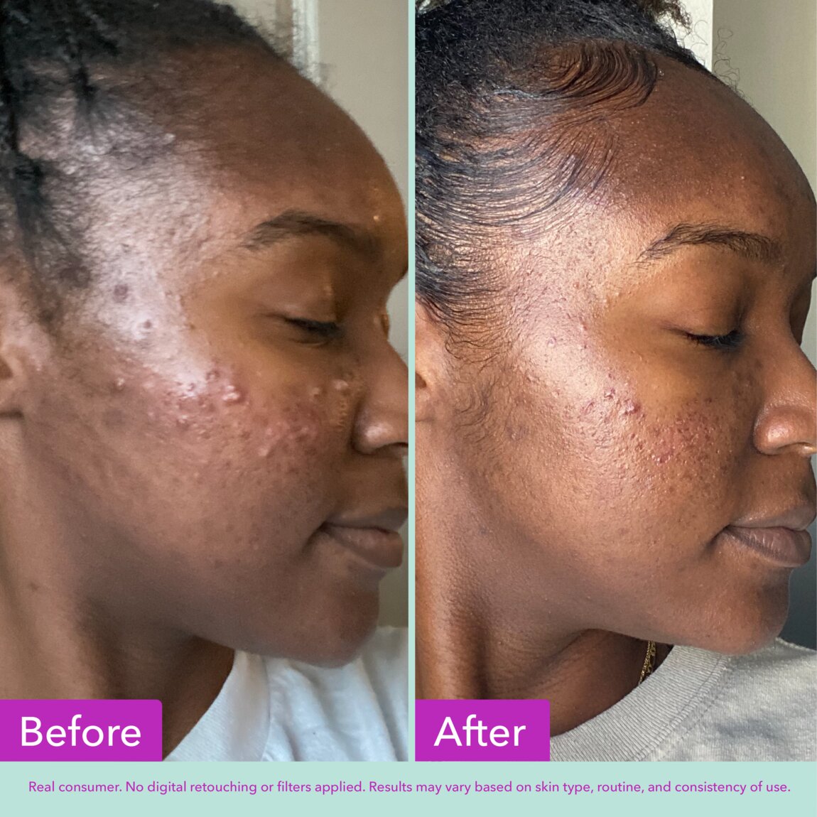 acne-foaming-cleanser-g6 zb_p.jpg
